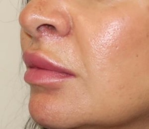 جراحی سانترال لب