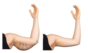 جراحی لیپو بازو