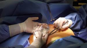 بهترین جراح پروتز سینه در کرج