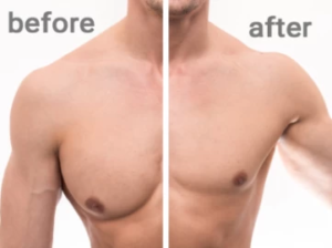 بهترین دکتر فوق تخصص جراحی ژنیکوماستی