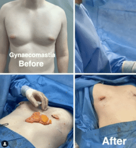 عمل ژنیکوماستی در تهران