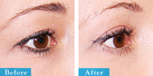 هزینه جراحی پلک بالا در تهران