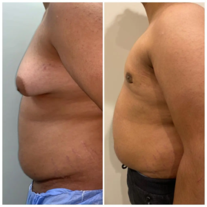 هزینه عمل ژنیکوماستی در سال 1404