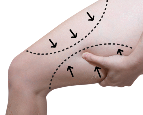 جراحی لیپوماتیک و لیفت ران