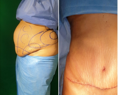 هزینه جراحی ابدومینوپلاستی