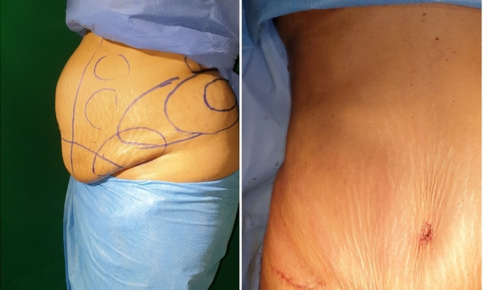هزینه جراحی ابدومینوپلاستی