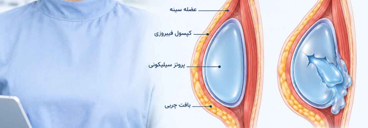 ترکیدن پروتز سینه