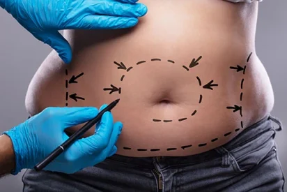 لیپو 360 درجه