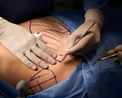 هزینه جراحی ابدومینوپلاستی