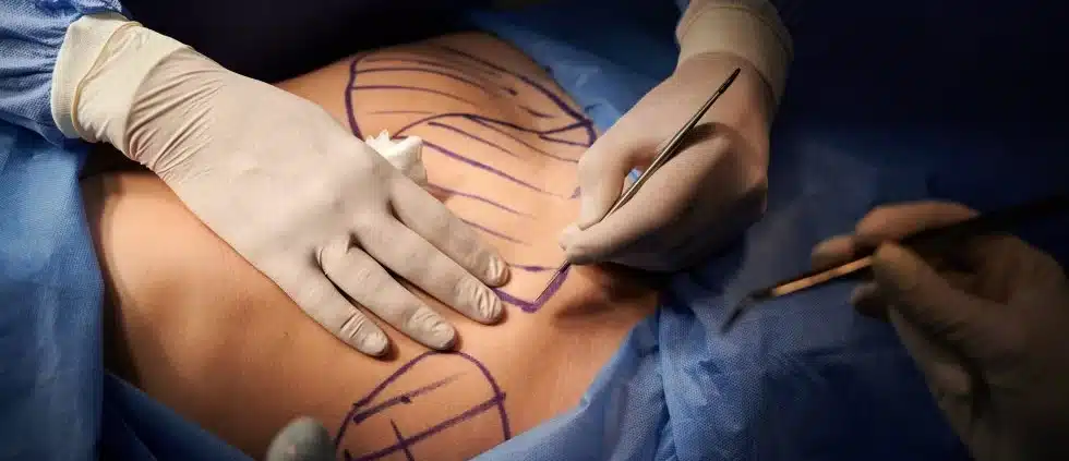 هزینه جراحی ابدومینوپلاستی